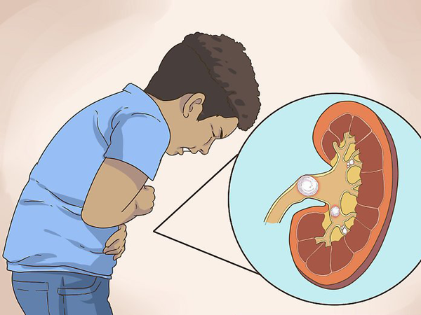 Hội chứng Bartter - Hình ảnh minh họa